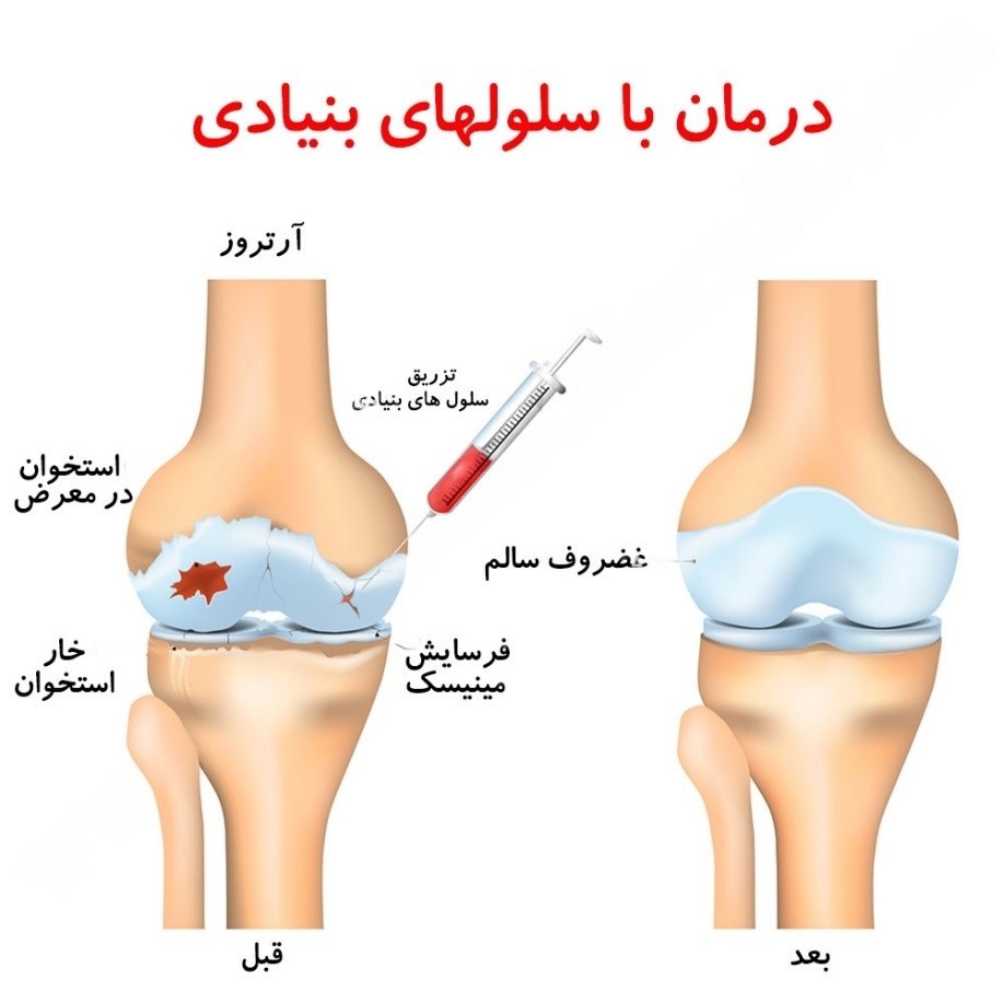 استفاده از تزریق سلول بنیادی برای درمان آرتروز